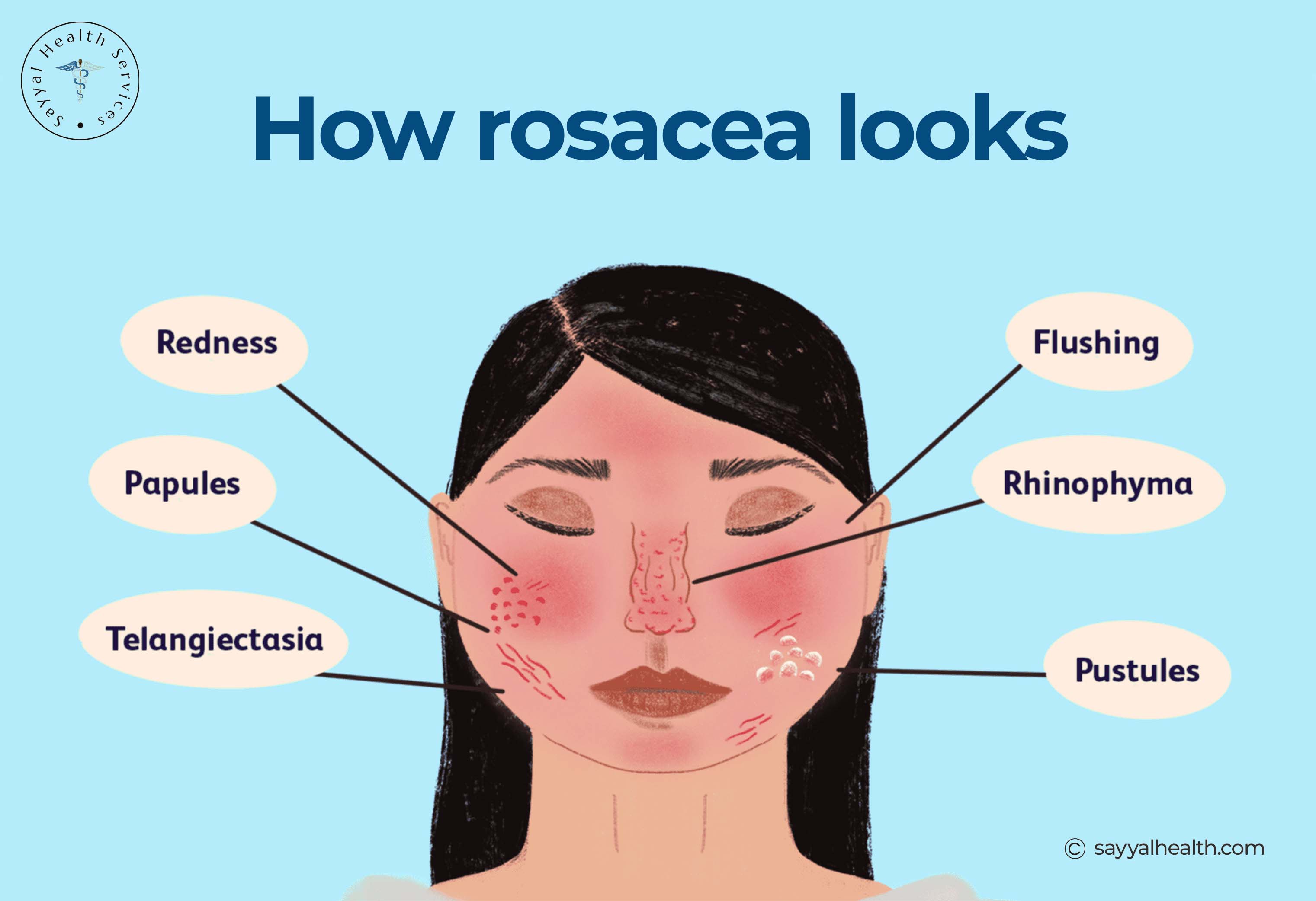 Rosacea symptoms diagram showing flushing, redness, papules, pustules, telangiectasia, and rhinophyma